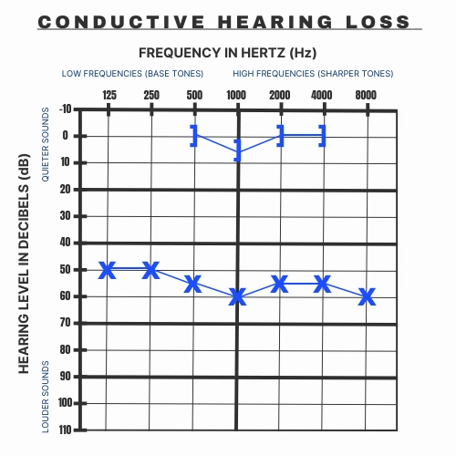 An example of what Conductive Hearing Loss looks like on an audiogram.
